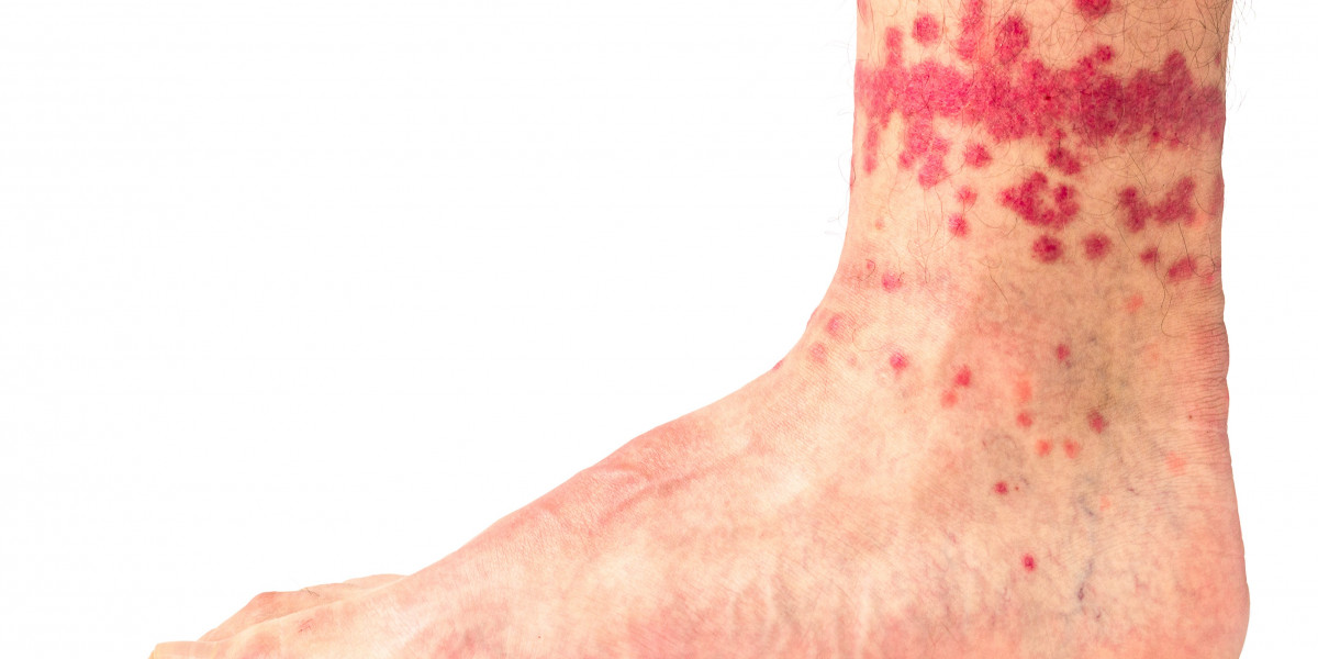 Advice About Fleas and Bites After Treatment Kiwicare